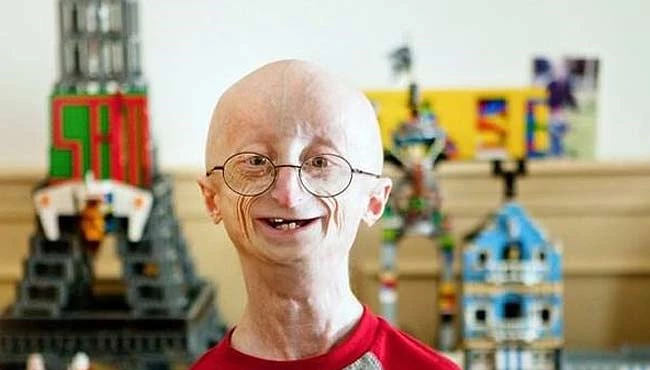 Progeria (Erken Yaşlanma Hastalığı) nedir?
